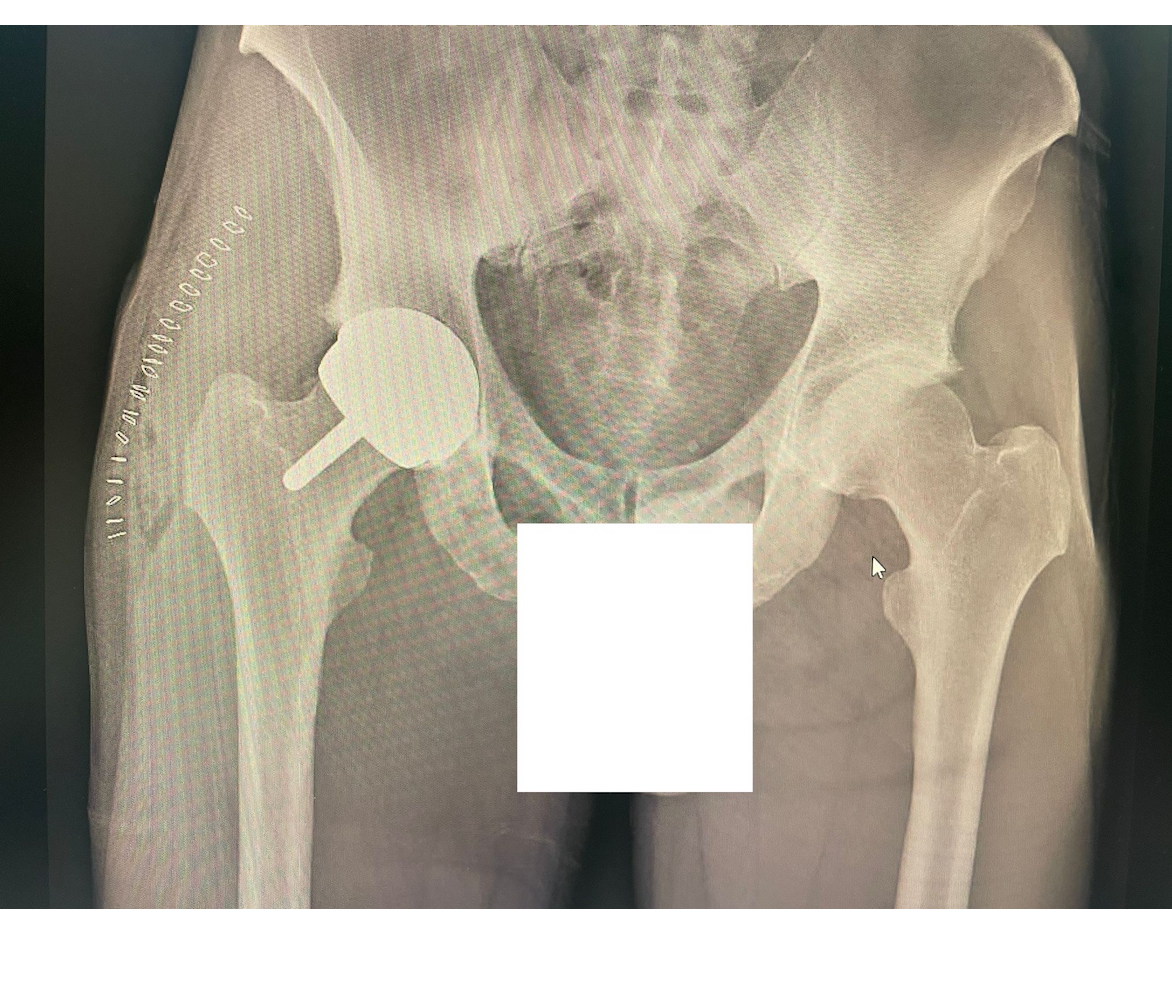 Radiografía de Hip Resurfacing