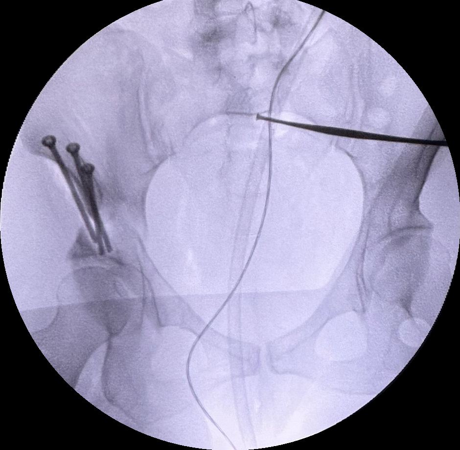 Control con fluoroscopia durante una osteotomía periacetabular realizada por el Dr. Nicolás Urueta